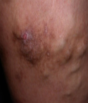 Image shows an example of VARICOSE ECZEMA