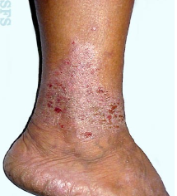 Image shows an example of STASIS GRAVITATIONAL ECZEMA