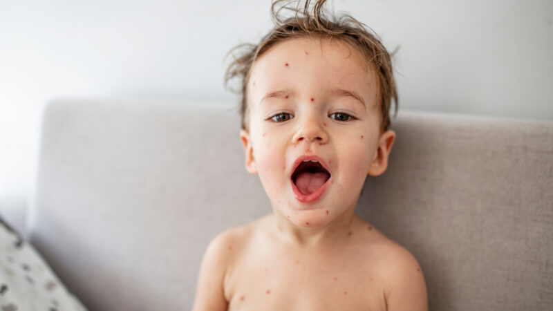 Young toddler with chickenpox. Sick child with chickenpox. Varicella virus or Chickenpox bubble rash on child. Portrait of little boy with pox.