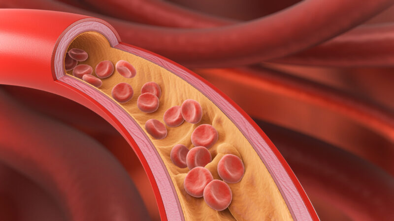 High Blood Cholesterol, Thickened Arteries and Veins, Red Blood Cells, 3d illustration.