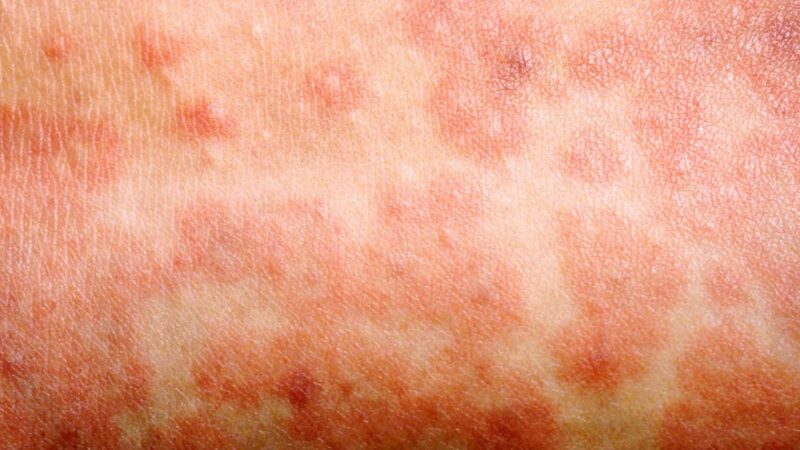 A_1017_measles-rash_D1BM7H.original.width-1534