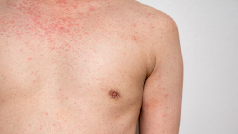 Dermatitis rash viral disease with immunodeficiency on body of young adult asian, scratch with itch, Measles Virus, Viral Exanthem